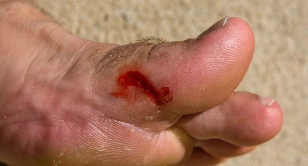 Nova Andradina registra a primeira fatalidade relacionada ao tétano