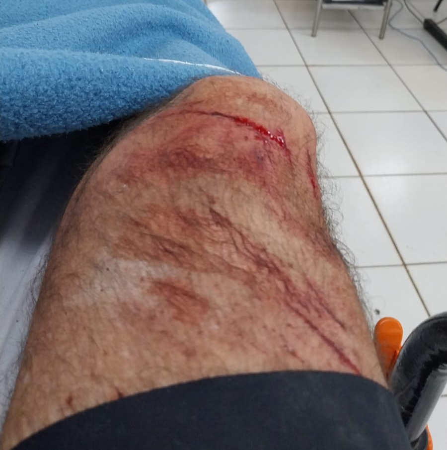 Ciclista sofre acidente em ciclovia sem sinalização em Campo Grande