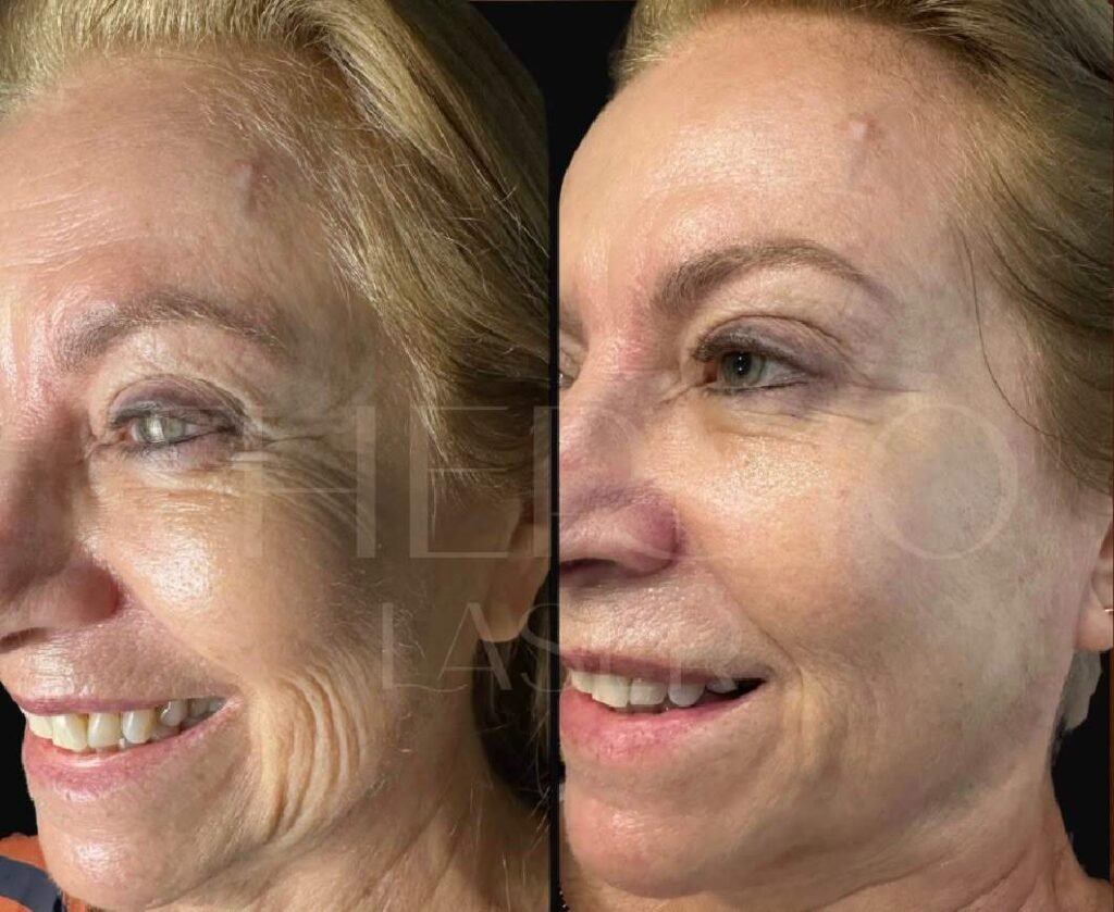 Nova técnica de estética reduz uso de preenchimentos ao estimular colágeno