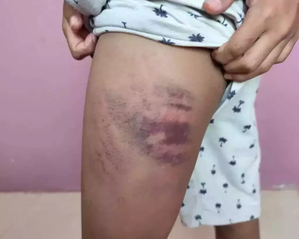 Mãe é investigada por agredir filho autista e tenta culpar colegas de escola